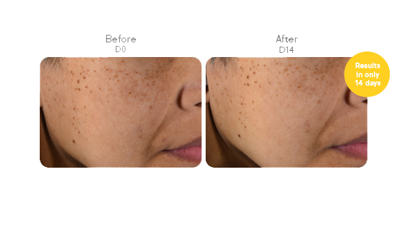 Close-up of a person's cheek showing multiple small, dark pigmented spots and uneven skin texture.