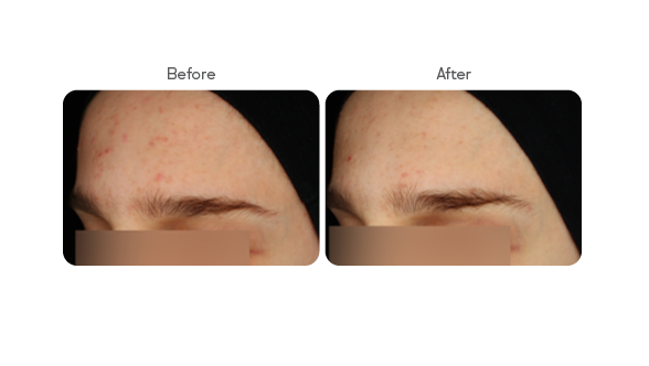 Side-by-side before and after images showing reduced acne and clearer skin on a person's forehead.