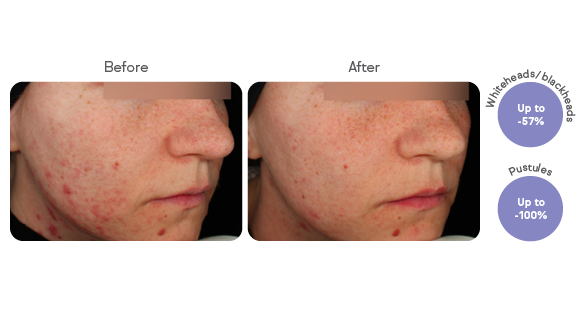 The image shows a comparison of skin condition before and after treatment. The "before" side displays more visible whiteheads, blackheads, and pustules, while the "after" side shows a significant reduction in these skin issues. The accompanying text indicates that whiteheads and blackheads have been reduced by up to 57%, and pustules have been reduced by up to 100%. This suggests the treatment is effective in improving skin clarity and reducing acne-related blemishes.